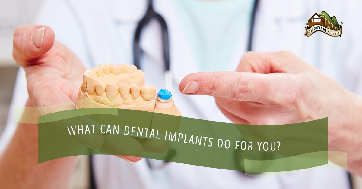 BlogBeauty-Bitterroot-TemplateWhat-Can-Dental-Implants-Do-For-You-59d5231ac675b